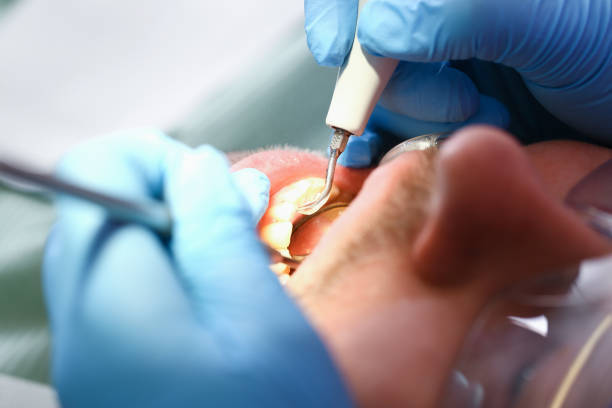 Best Emergency Dental Extractions in Cass City, MI